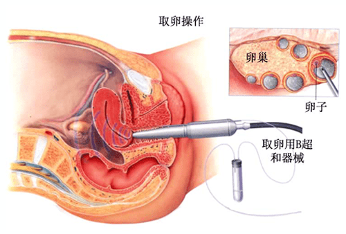 供卵试管婴儿前3个月如何调理身体