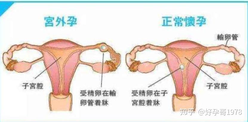 卵泡长不大能做试管婴儿吗